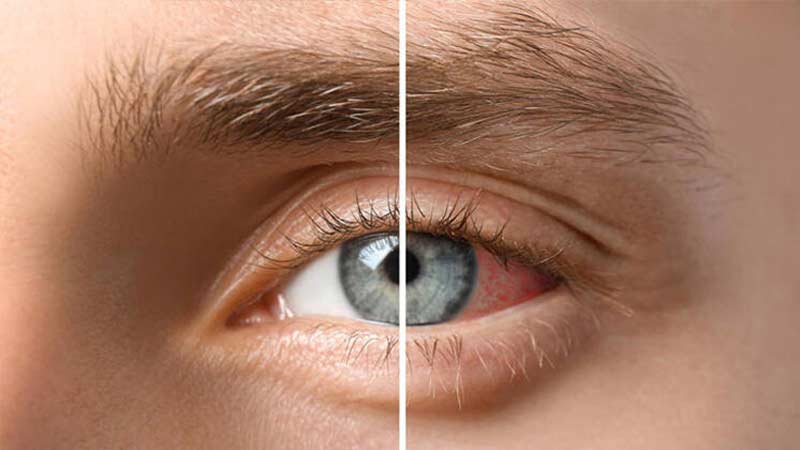 پروبیوتیک به درمان بیماری خشکی چشم کمک می کند