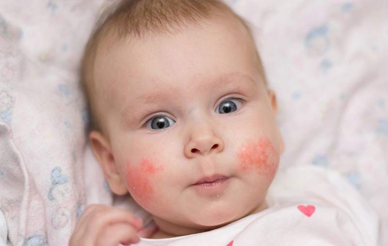 آلرژی‌های پوستی نوزادان به چه شکل ظاهر می‌شوند؟