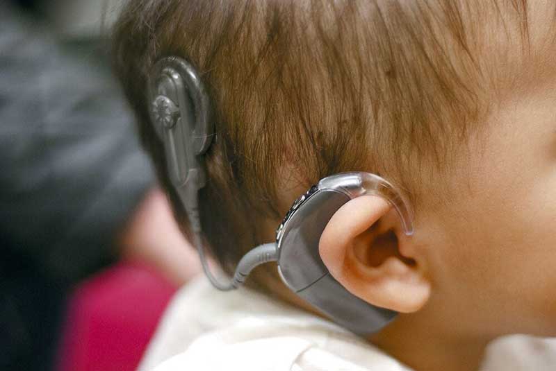 کاشت 2 هزار پروتز حلزون شنوایی برای کودکان