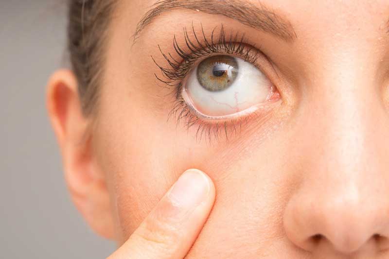 بهترین درمان خشکی چشم کدام است؟