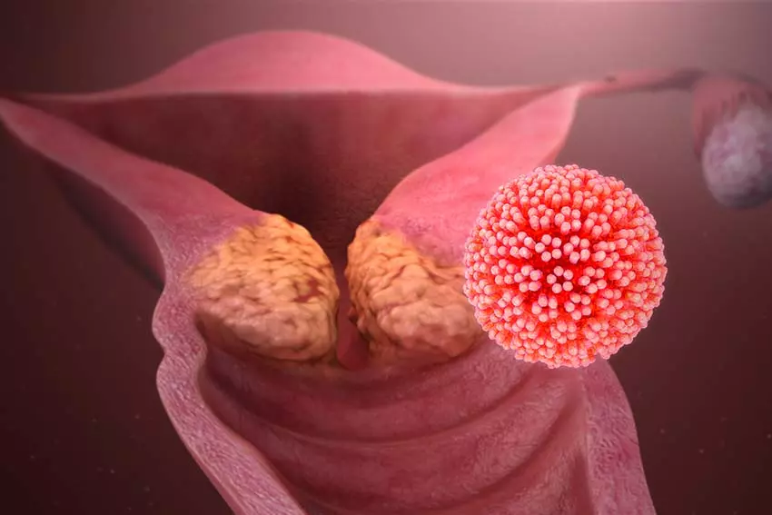 ۱۰ نشانه عفونت زگیل تناسلی یا HPV