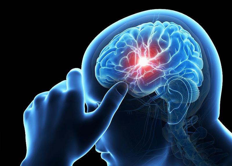 زمان طلایی برای رسیدگی به بیماران سکته مغزی