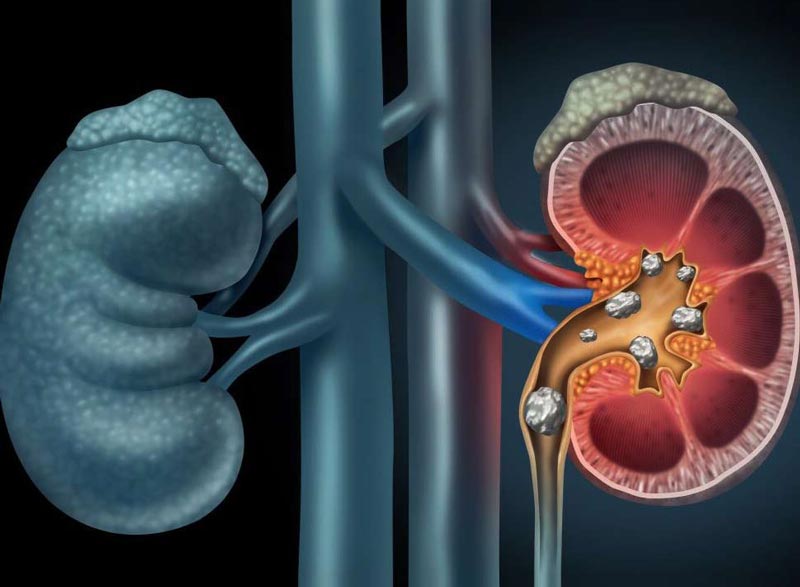 انواع سنگ کلیه و درمان‌های تغذیه‌ای آن