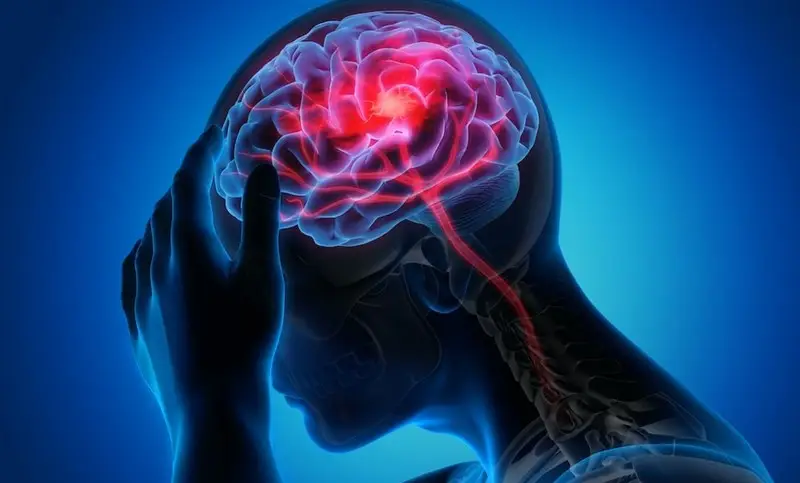 سکته مغزی دومین عامل مرگ در کشور/ روزانه 200 تهرانی دچار سکته مغزی میشوند